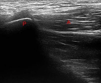 The Case of Insertional Adductor Tendinopathy of an International-Level 3,000-m Steeplechase Runner